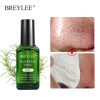 چسب جوش سرسیاه بینی بریلی BREYLEE